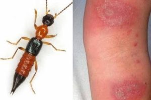 ‘नाइरोबी फ्लाई’ डरलाग्दो र भयानक रोग होइन : डा ढकाल