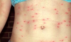 बागलुङमा डेंगुका भन्दा स्क्रब टाइफसका बिरामी बढी