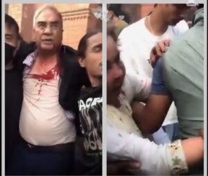 देउवाको टाउकोमा १२ टाँका, अझै केहीदिन अस्पतालमा रहने