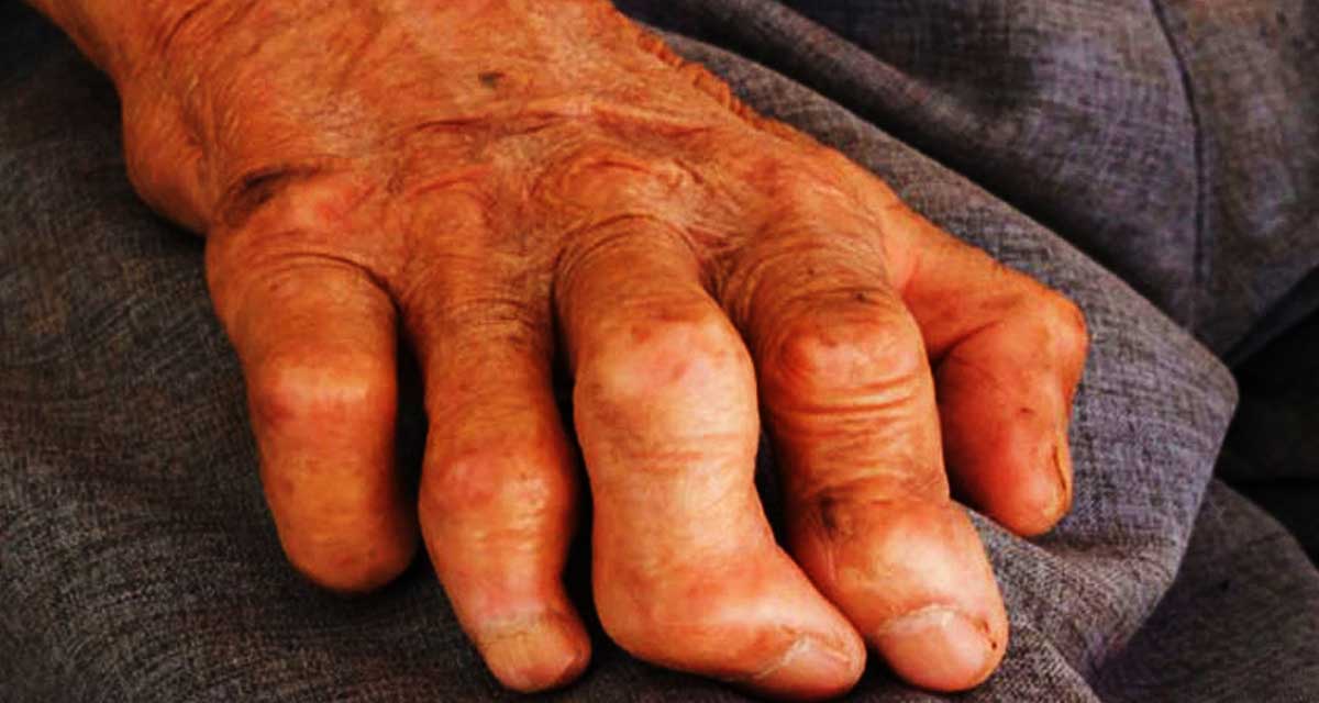 जाजरकोटमा १८ जना कुष्ठरोगी उपचाररत